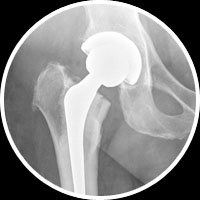 Total Hip Replacement