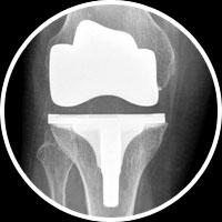 Total Knee Replacement